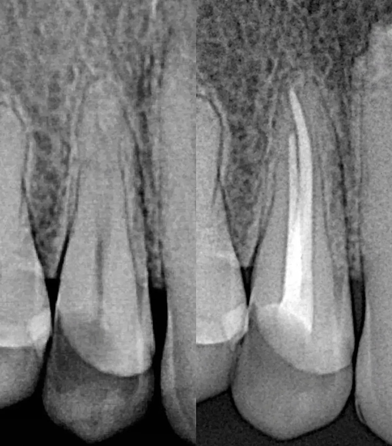 Endodoncia