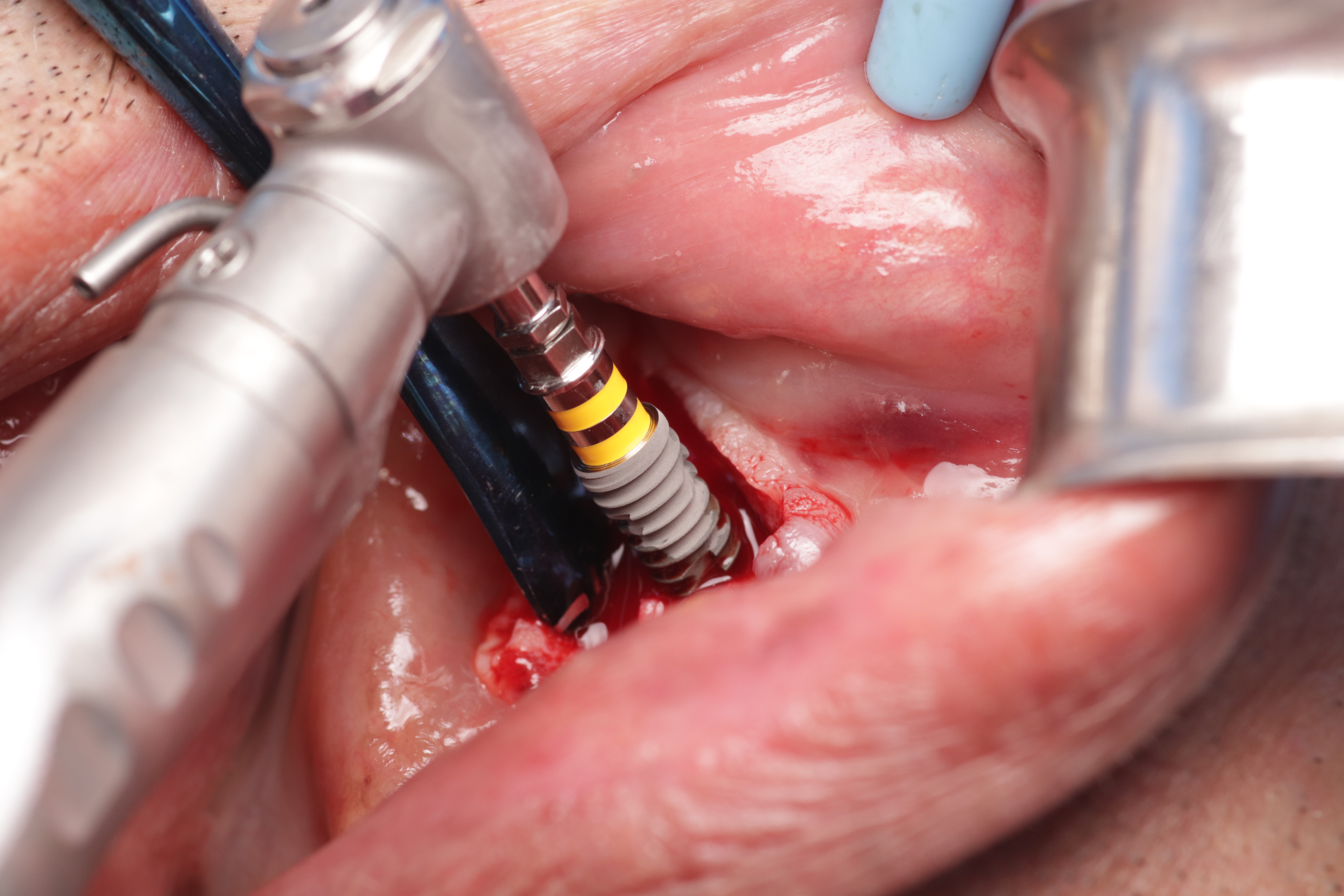 Implantología y Cirugía Oral