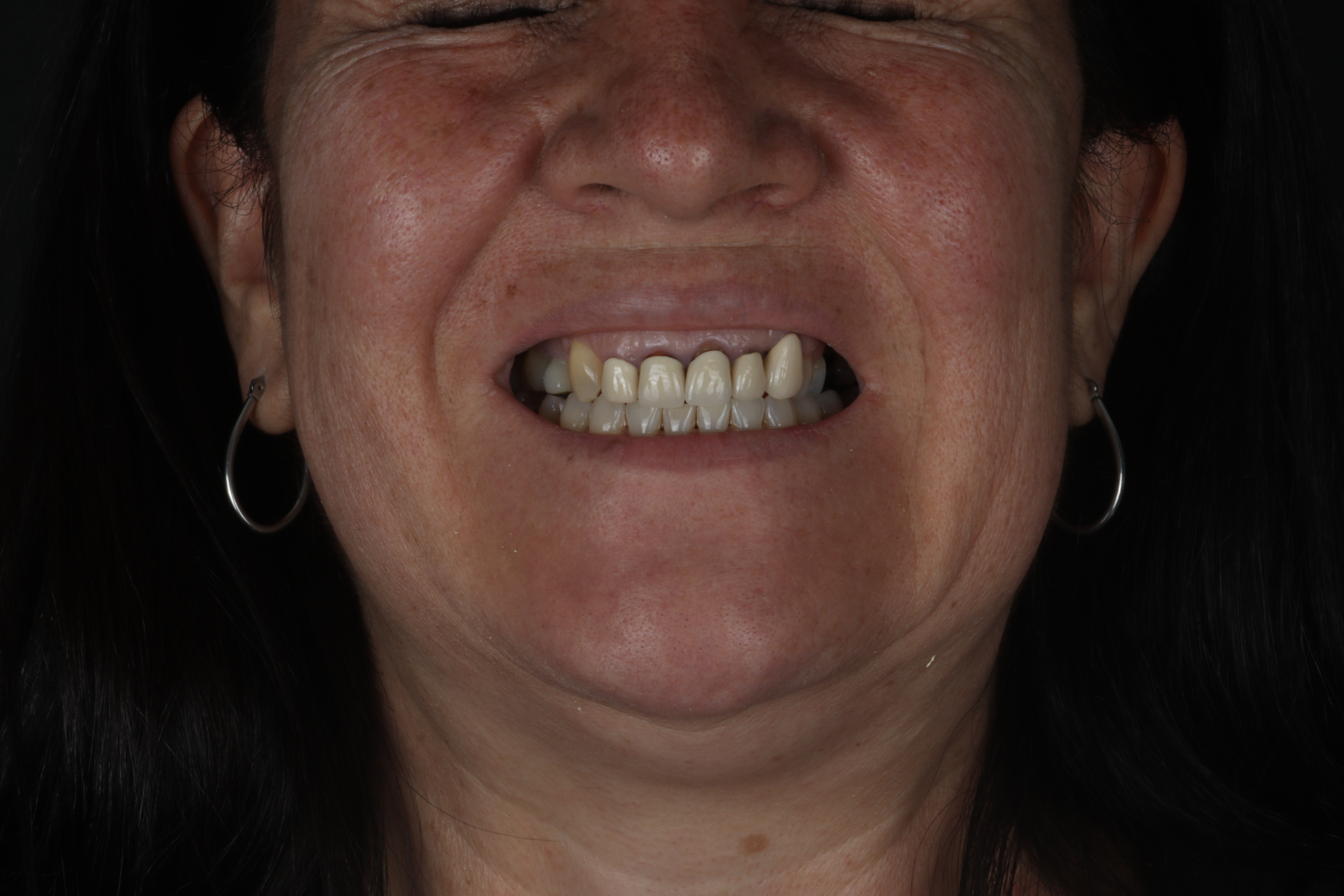 Antes