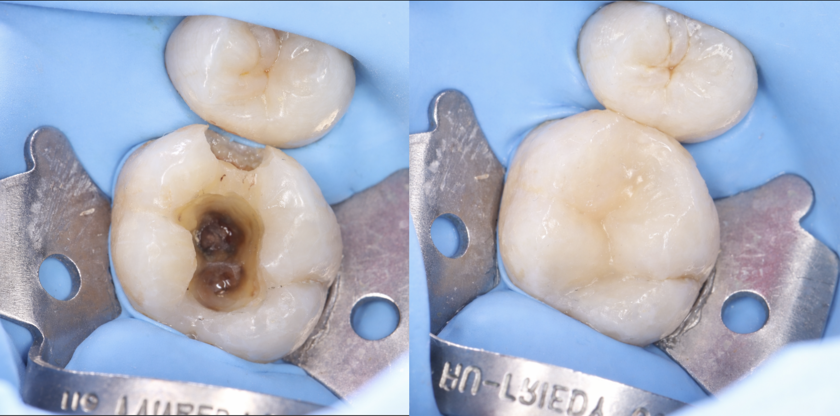 Endodoncia